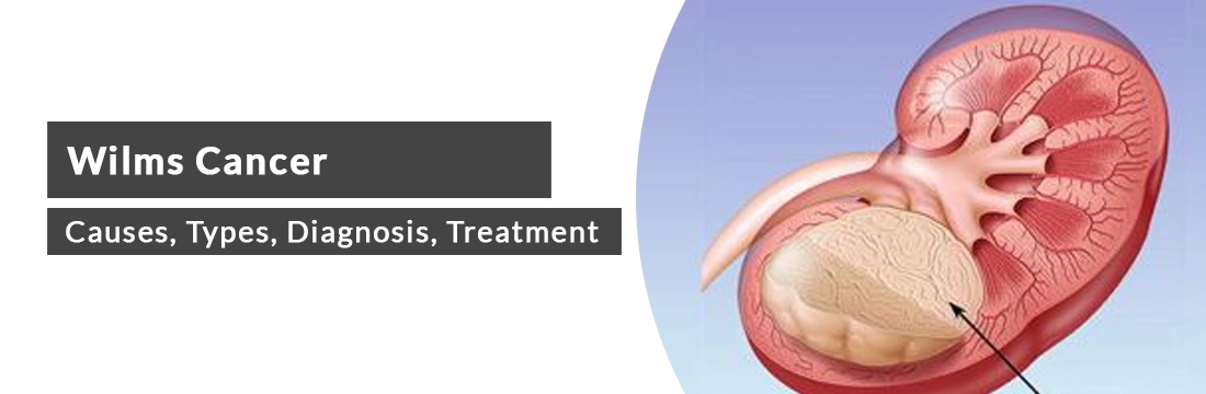 Wilms Cancer: Definition, Causes, Types, Diagnosis, Treatment, Prevention and Cost